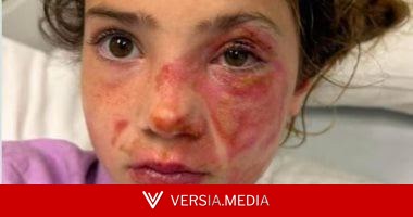 تحذيرات فى بريطانيا من لعبة مطاطية تسببت فى حروق بالغة للأطفال