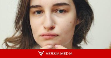 هذه الأنواع من الأطعمة سبب فى زيادة حب الشباب ..كيف يمكن الوقاية ؟